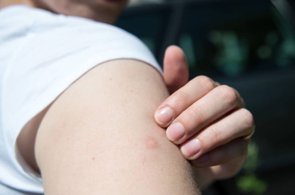 Allergische reaktion auf mückenstich